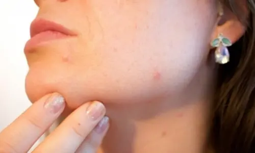 New immunotherapy strategy hope for psoriasis and vitiligo patient