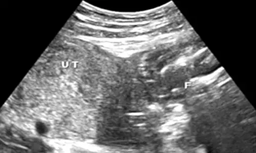 BMC hospital saves mother with ruptured uterus having dead baby