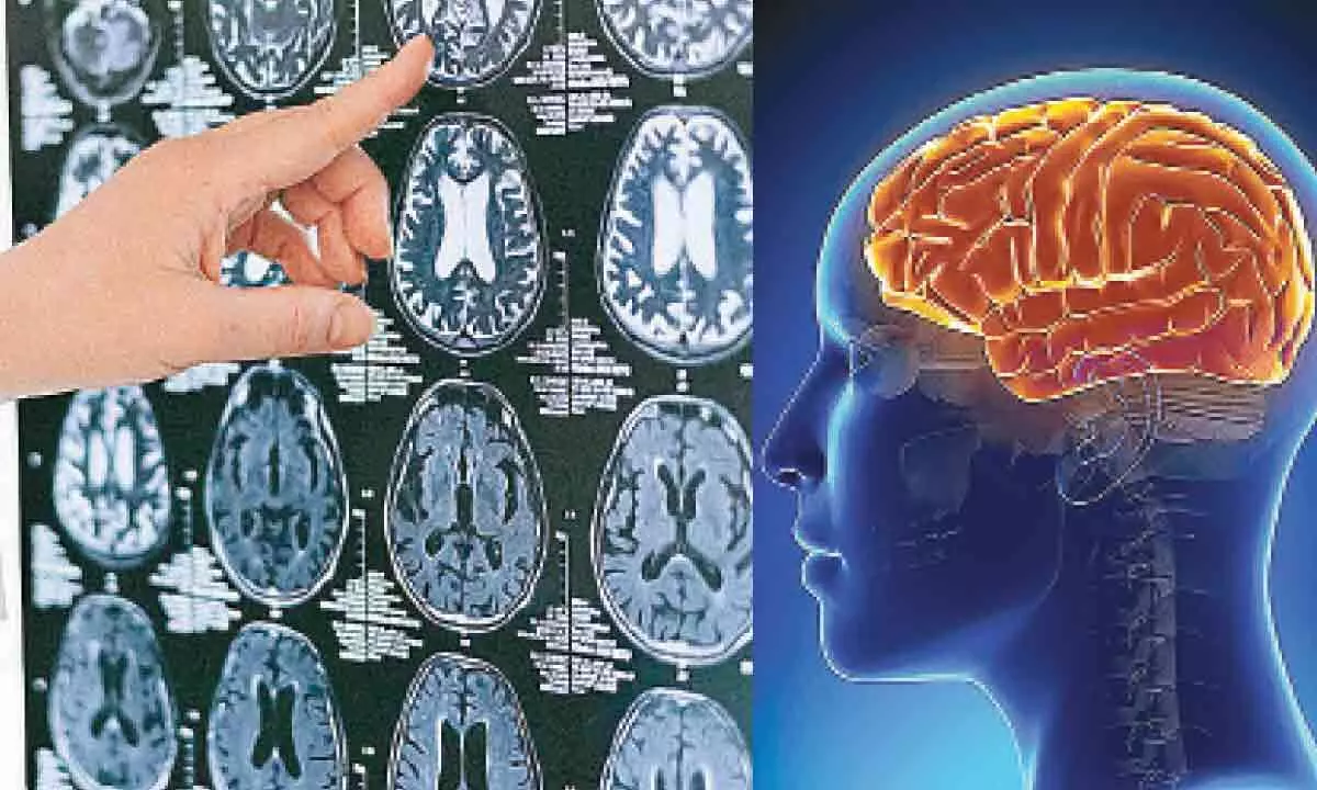 Debunking five traumatic brain injury myths