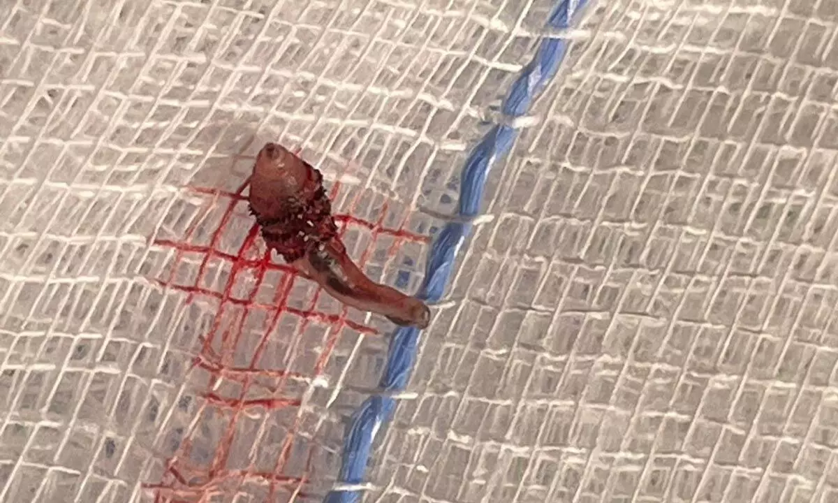 Bengaluru Doctors Remove Live Botfly Larvae from 26 Year Olds Scalp