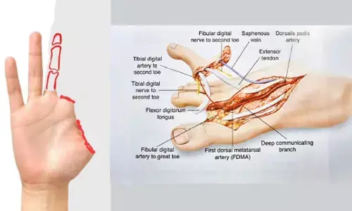 Techie gets a toe for lost thumb in fire cracker injury
