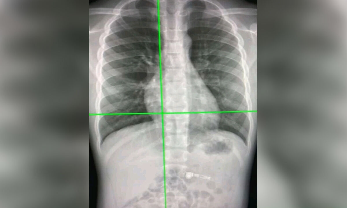 New AI tool can detect Covid infection from chest Xrays 98 accuracy