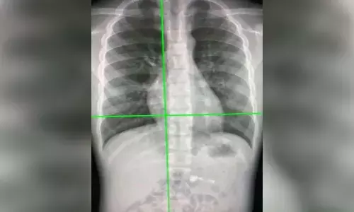 New AI tool can detect Covid infection from chest X-rays 98% accuracy