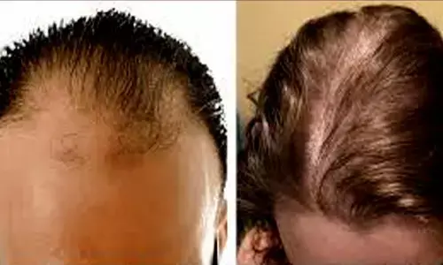 hair loss: Latest News, Videos and Photos of hair loss