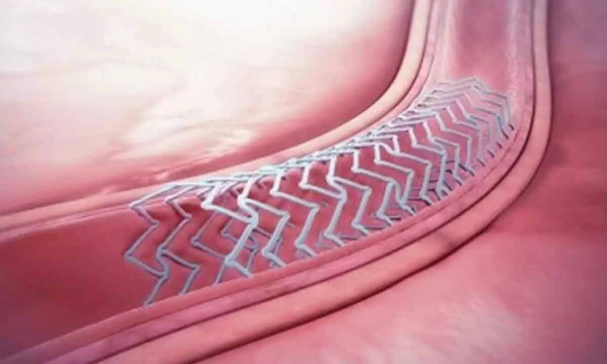 India’s coronary drug-eluting stents mkt to see 4% CAGR by 2033