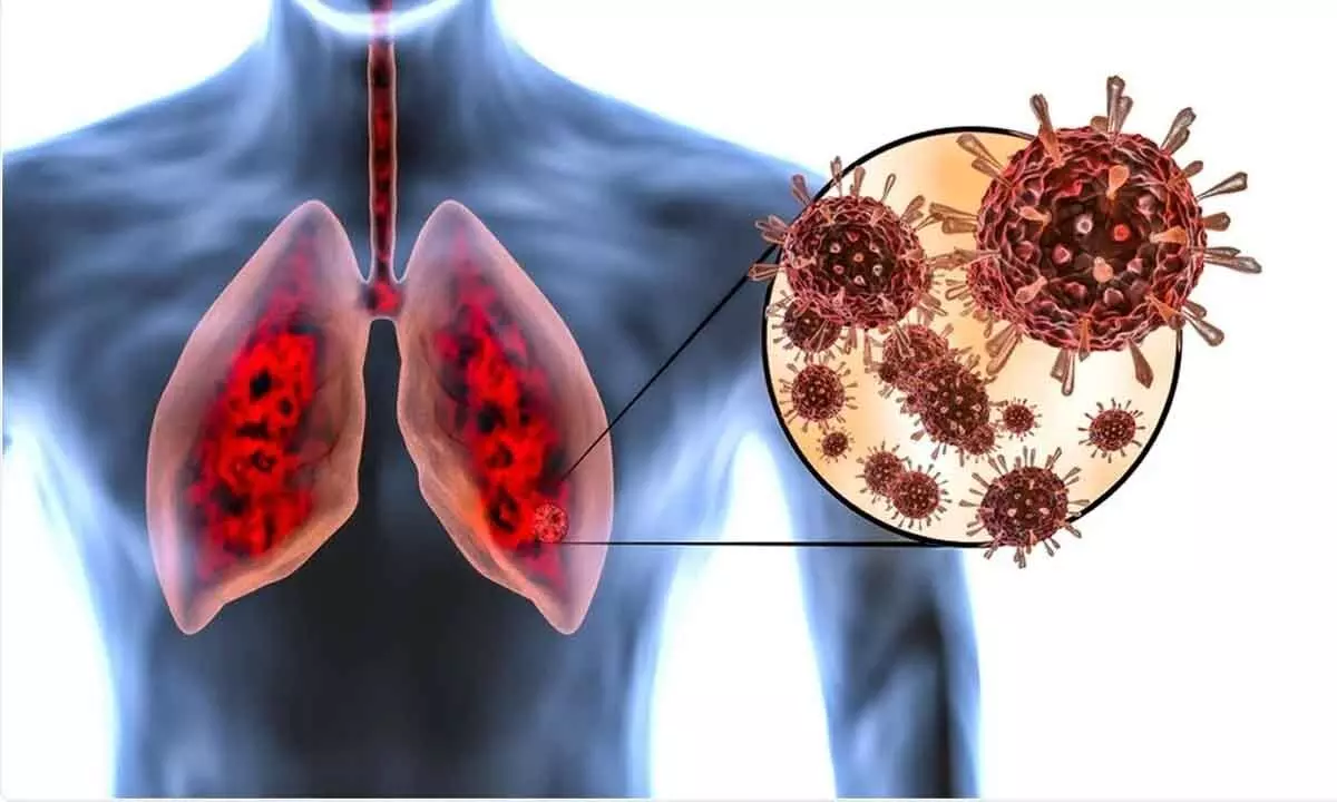 Fatal lung disease behind Covid deaths?