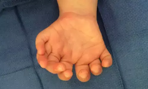 Study finds rare disorder behind extra fingers and toes