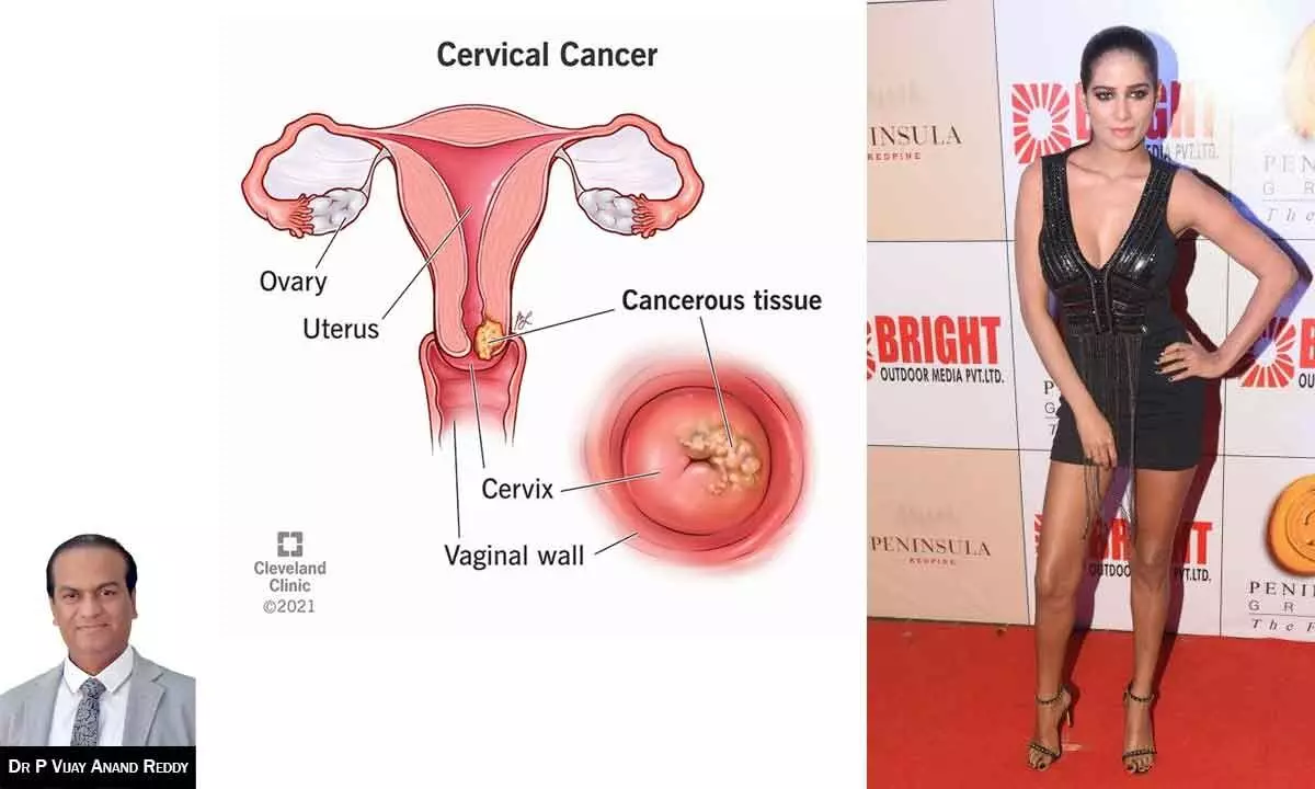 Cervical cancer and the human papilloma virus vaccination