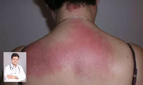 Understanding Dermatomyositis in light of Suhani Bhatnagar’s passing