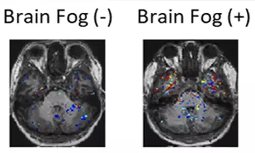 Leaky blood vessels behind Long Covid-linked brain fog, says study