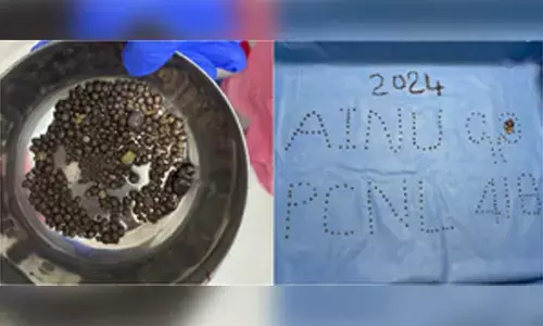 418 kidney stones removed from patient at Hyderabad’s AINU
