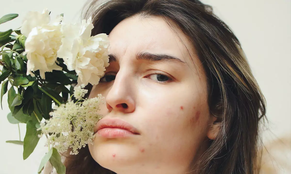 Acne spots, a stubborn reminder that you need glutathione