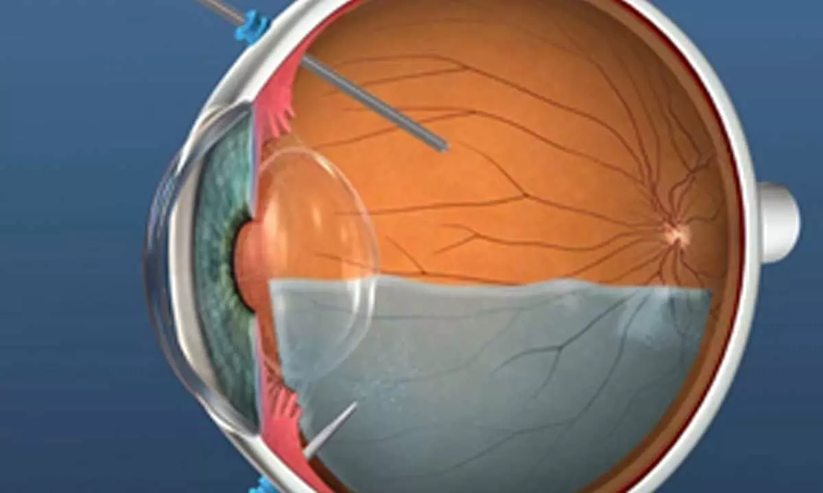 Vitrectomy: The surgery to treat retinal damage due to diabetes or digital screens