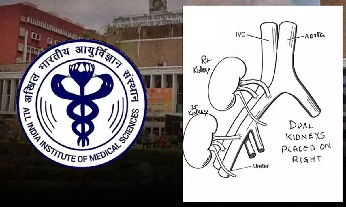 AIIMS-Delhi Performs Groundbreaking Dual Kidney Transplant Surgery