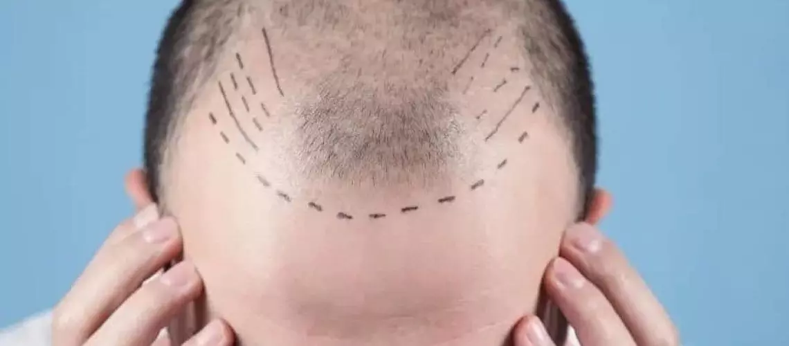 Choosing the Right Clinic: Essential Considerations for Hair Transplant Seekers