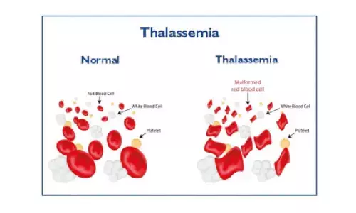 Experts call for equitable access to healthcare for blood cancer patients