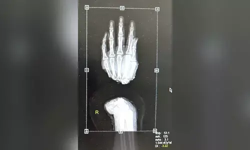 Delhi-based doctors successfully transplant hand of a daily wage labourer