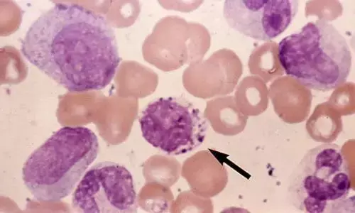 Embracing Life with CML - A Comprehensive Guide to Proactive Management