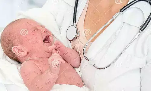 12% children received no dose of measles vax: Study