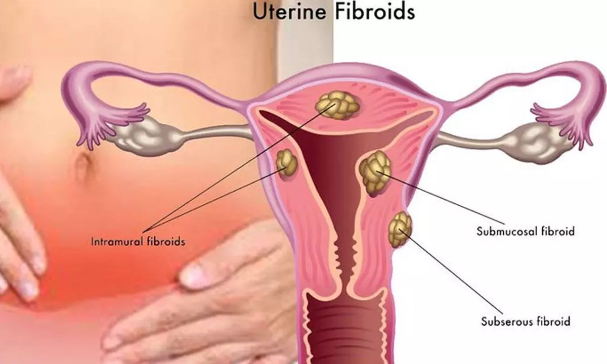 “A woman’s health is her capital “: Fibroids?