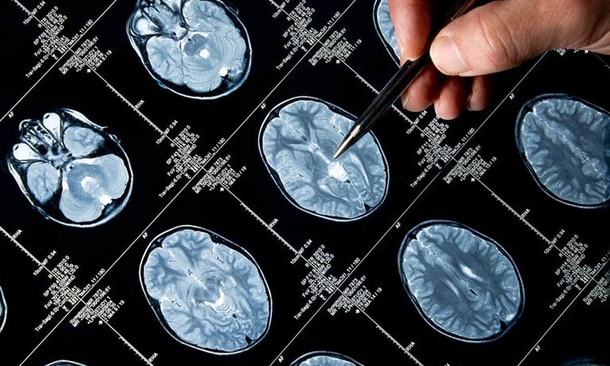 Early diagnosis crucial as brain tumour cases rise globally