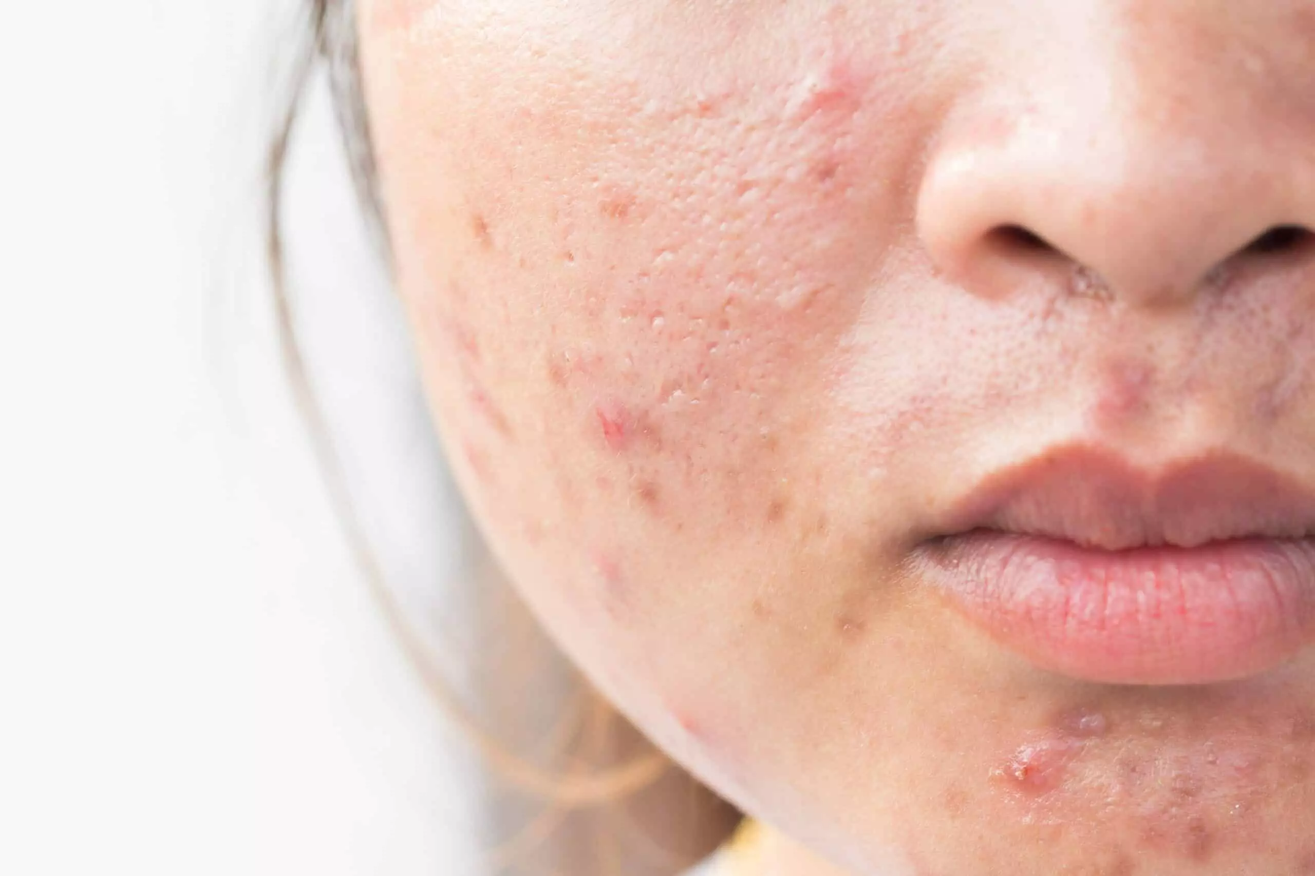 Effective Home Remedies for Acne Scars: Natural Solutions for Clearer Skin