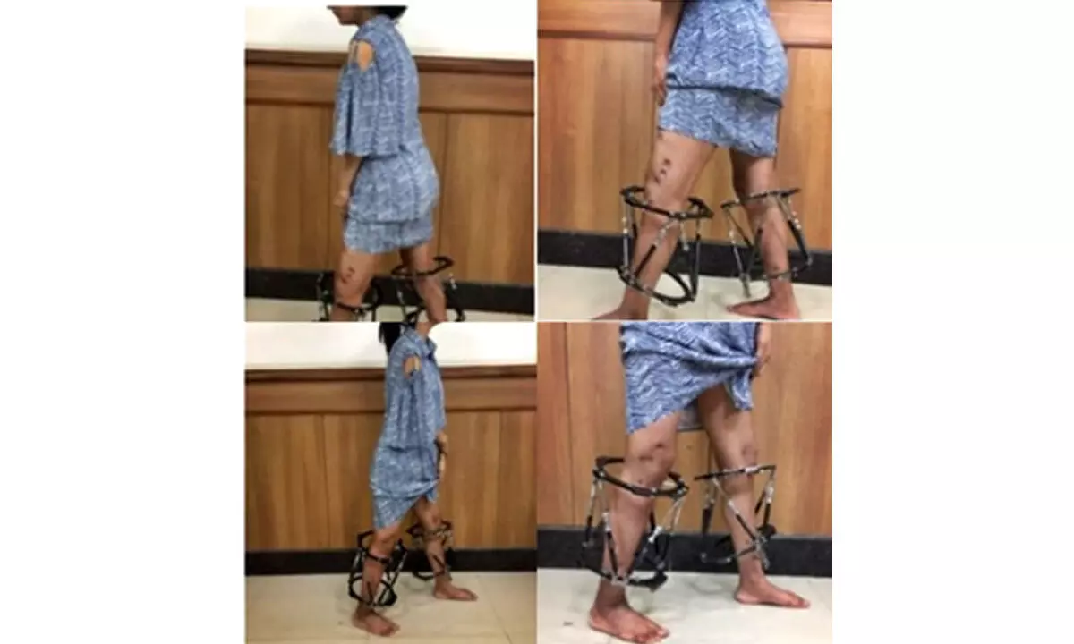 New AI-assisted technique makes teenage girls crooked legs straight