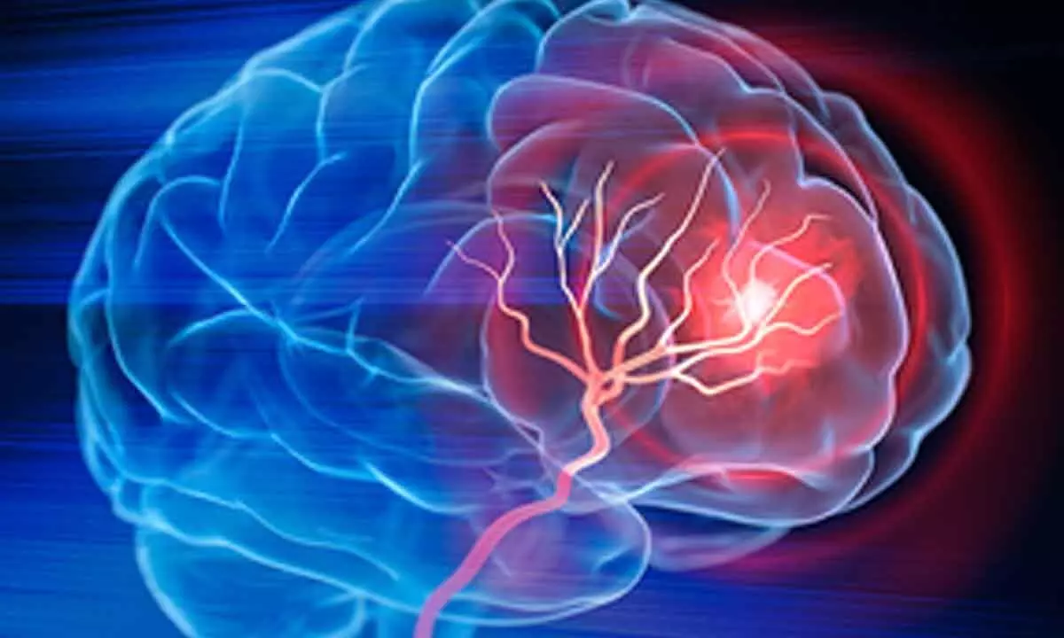 Delhi-NCR doctors treat life-threatening brain aneurysm condition with novel technique