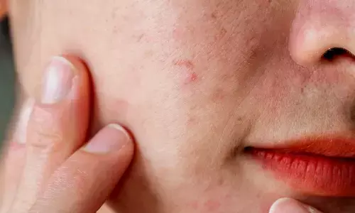 Struggling with Acne? Discover How Hydration Can Help Clear Your Skin