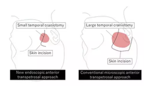 Novel brain surgery technique targets difficult tumours at skull base
