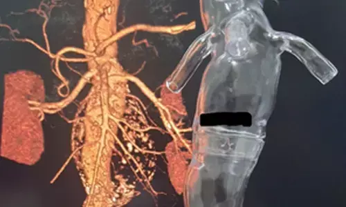 Bengaluru doctors treat Iraqi patient with 11cm large abdominal aneurysm