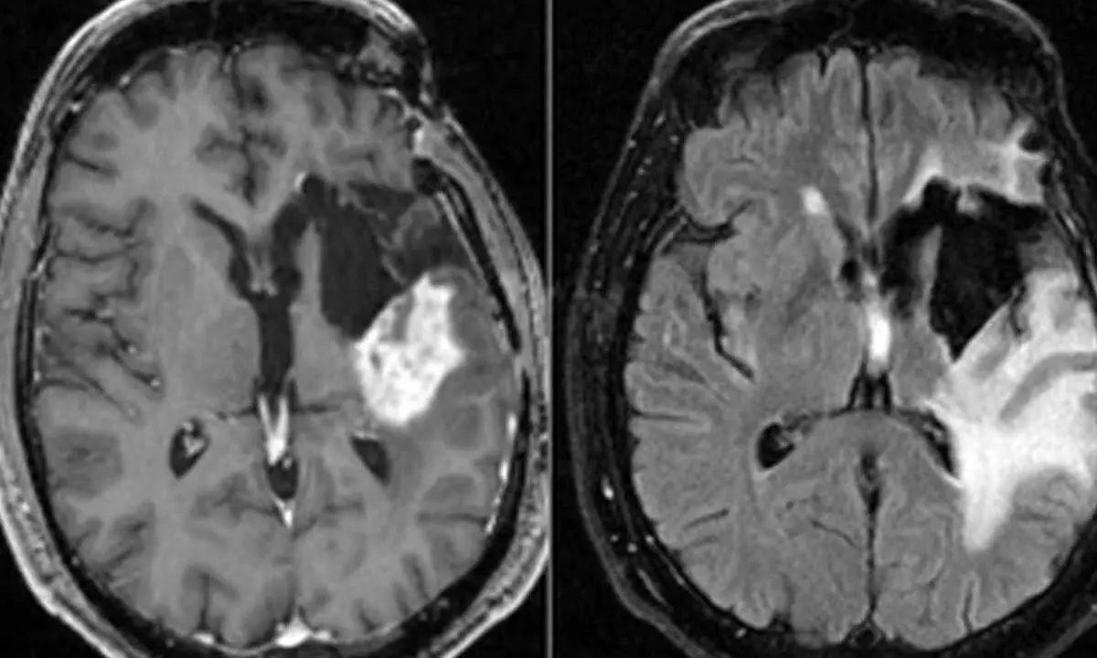 Potent immune cells found near glioblastomas, a possible cure