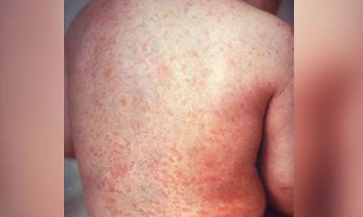 Mongolia reports two additional measles cases