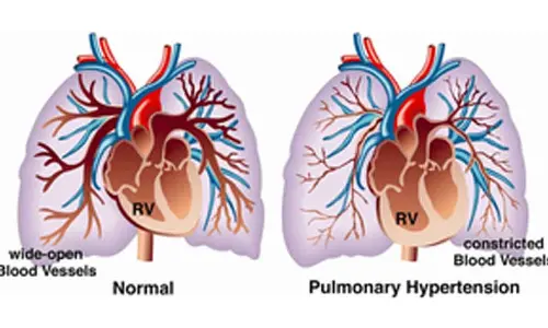 Indian scientists find 4 previously overlooked genes to fight deadly lung condition