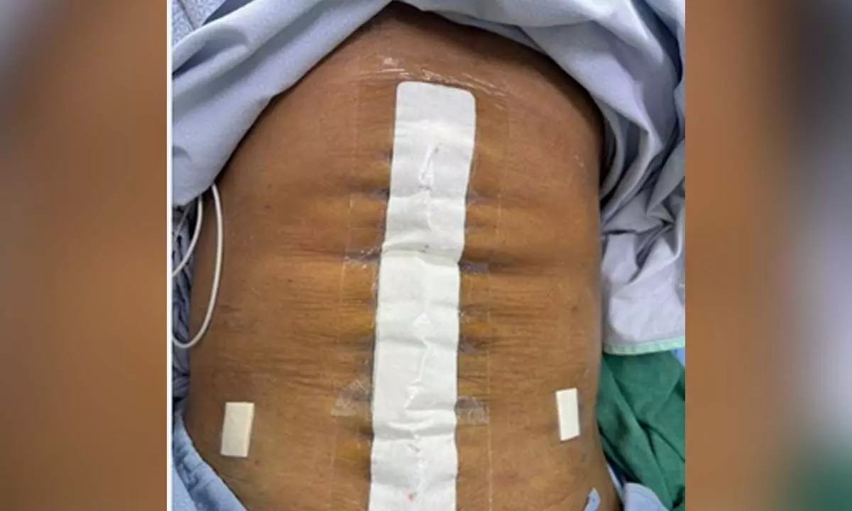 Doctors treat 70-year-old man with severe abdominal hernia