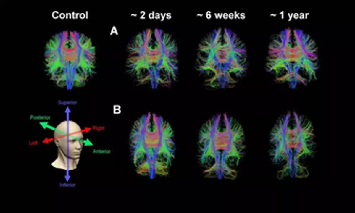 New MRI technique may better predict fatigue, headaches in concussion patients