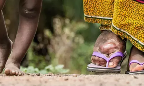 Centre launches phase 2 of mass drug administration campaign to eradicate elephantiasis