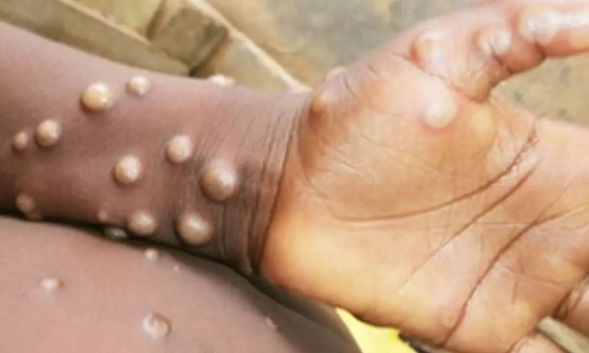 No threat of mpox spread in Russia: Authorities