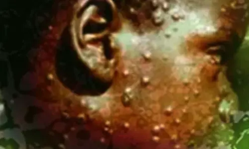 WHO declares global health emergency over Mpox outbreak