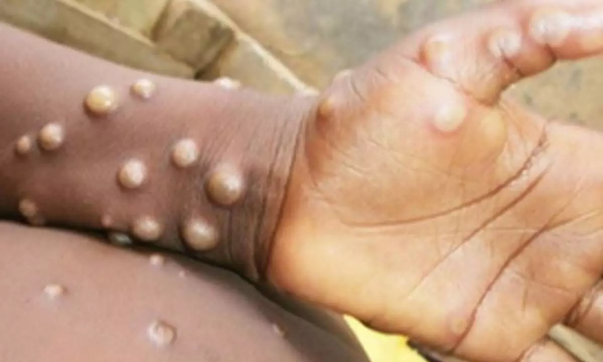 China tightens precautions at ports as global mpox cases increase