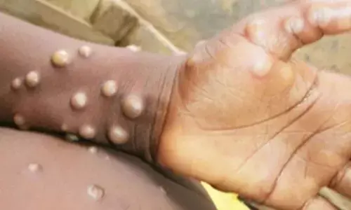 No reported case of Mpox in India, PM continuously monitoring situation: Centre