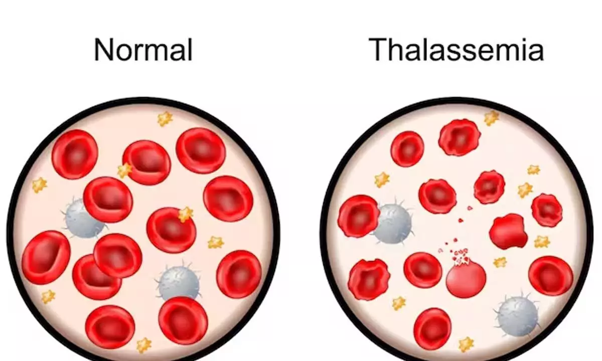 Thalassemia Awareness: The Importance of Screening for Aspiring Parents