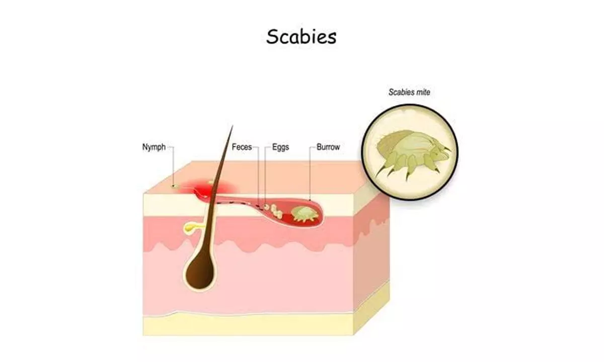 How to Deal With Scabies?