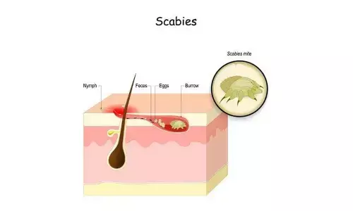 How to Deal With Scabies?