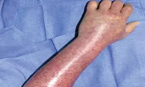 Bengaluru doctors save 25-year-old mother suffering from acute liver failure