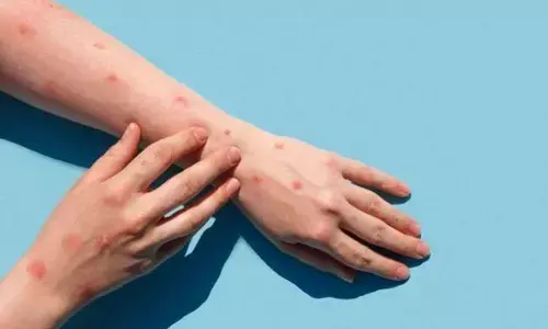 Telangana State gets ready to tackle Mpox, special wards set up in hospitals