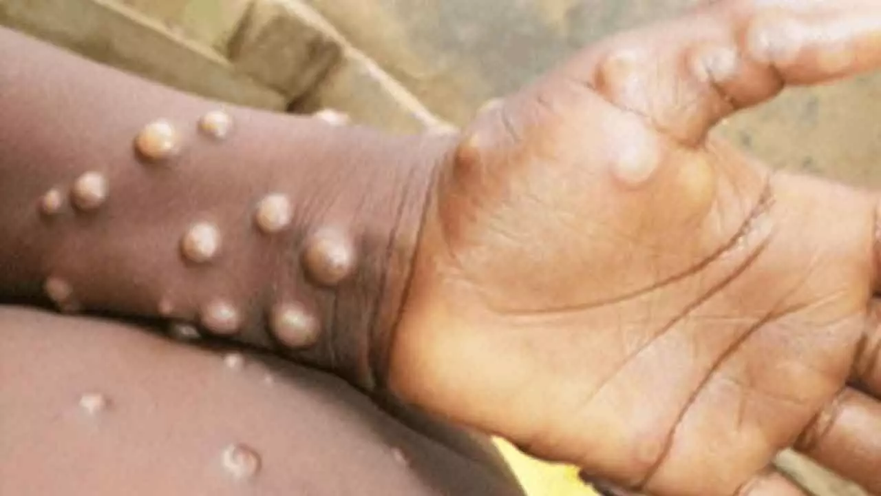 Africa CDC warns of rising mpox cases, launches response plan with WHO