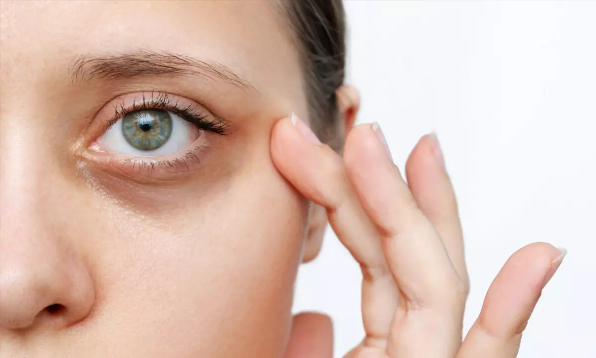 Effective Natural Remedies to Reduce Dark Circles