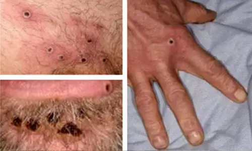 WHO prequalifies Bavarian Nordic’s vaccine against Mpox