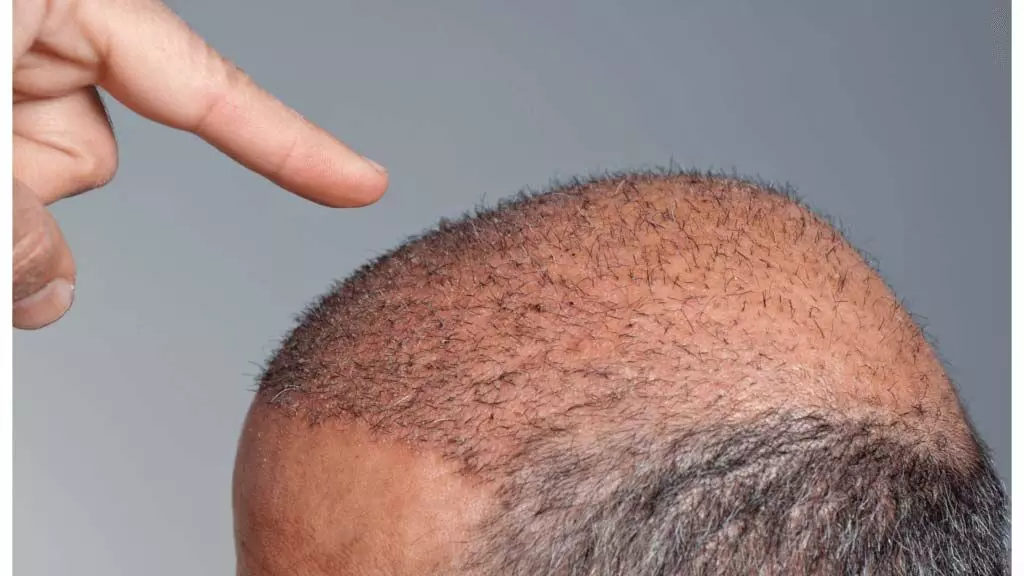 Is a Hair Transplant the Right Choice for Men?